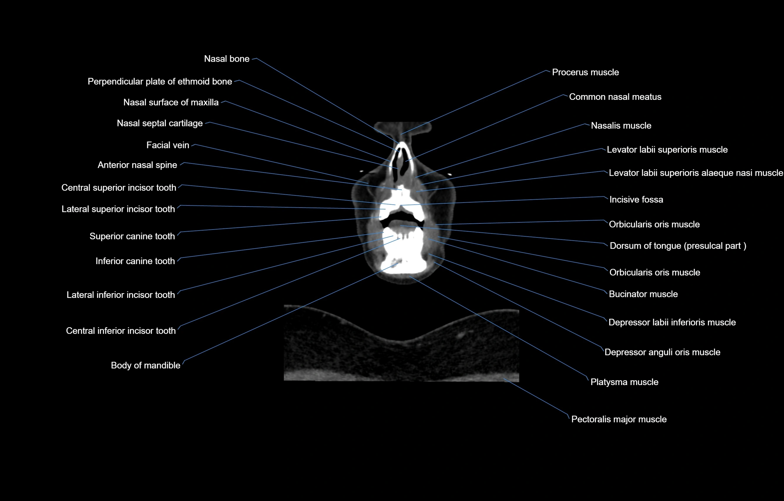 CT Neck coronal  cross sectional anatomy labelled 3D  radiology  image-00009.webp